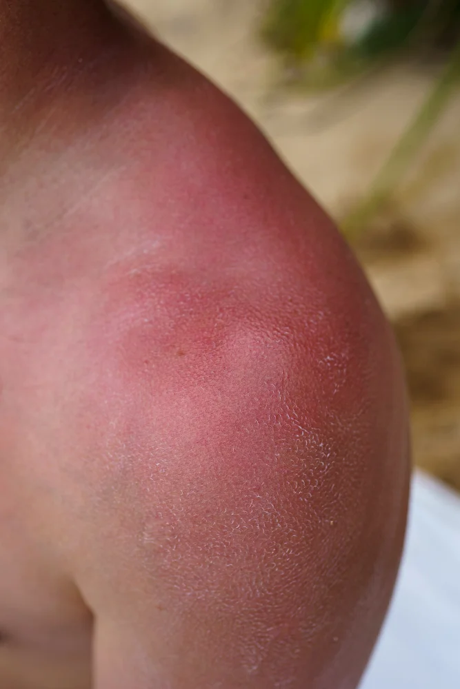 Sputum Eosinophil, eosinophil bronchitis, Sputum Eosinophil test clinic in kolkata, best Sputum Eosinophil test for eosinophil bronchitis