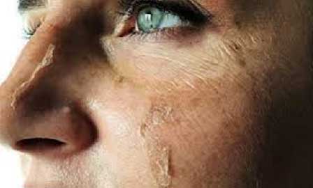 Chemical peeling Kolkata, Best chemical peeling clinic Kolkata, Chemical peel treatment Kolkata, Top dermatologist for chemical peeling in Kolkata, Chemical peel for skin rejuvenation in Kolkata, Effective chemical peeling Kolkata, Dermatological clinic for chemical peeling Kolkata, Advanced chemical peeling options Kolkata, Professional chemical peeling treatment Kolkata, Chemical peeling specialist Kolkata