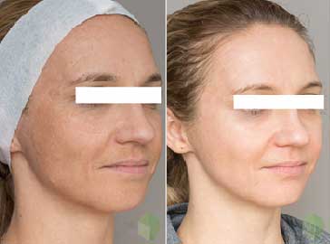 Freckles treatment Kolkata, Best freckles treatment clinic Kolkata, Freckles removal Kolkata, Top dermatologist for freckles treatment in Kolkata, Laser treatment for freckles in Kolkata, Effective freckles treatment Kolkata, Dermatological clinic for freckles treatment Kolkata, Advanced freckles treatment options Kolkata, Freckles specialist Kolkata, Professional freckles treatment in Kolkata