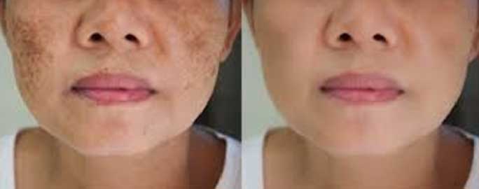 Melasma treatment Kolkata, Best melasma treatment clinic Kolkata, Melasma specialist Kolkata, Melasma removal Kolkata, Top dermatologist for melasma treatment in Kolkata, Laser treatment for melasma in Kolkata, Melasma pigmentation treatment Kolkata, Effective melasma treatment Kolkata, Dermatological clinic for melasma treatment Kolkata, Advanced melasma treatment options Kolkata